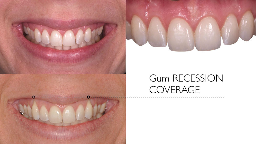 Gum graft before and after transitions with gum recession coverage