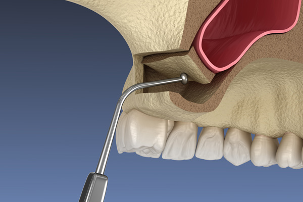 Sinus Lift Surgery - Moving sinus membrane 3D illustration in Glenview office.