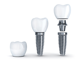 a 3D rendering of a dental implant and its parts