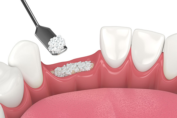 3D rendering of a bone graft being placed