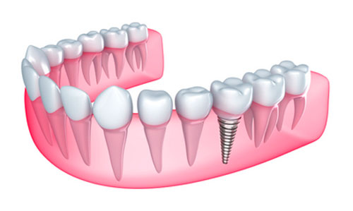 How Long Do I Expect My Dental Implants to Last?