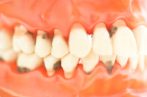 Photo of gingivitis gum model from Glen Perio in Glenview, IL