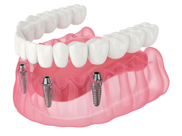 Diagram of All on X full arch dental implants