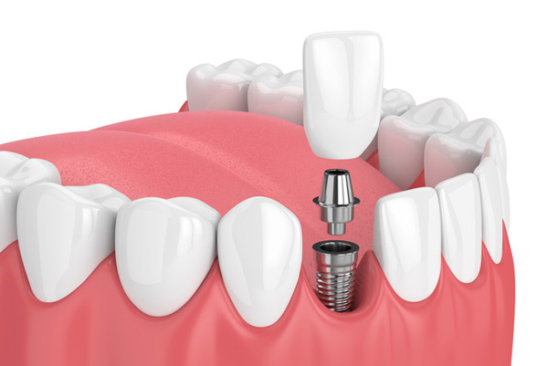 Photo of dental implants from Glen Perio in Glenview, IL