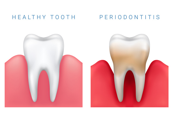 Photo of healthy and gum disease teeth at Glen Perio in Glenview, IL