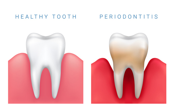 Diagram of healthy tooth compared to periodontitis diseased tooth at Glen Perio in Glenview, IL