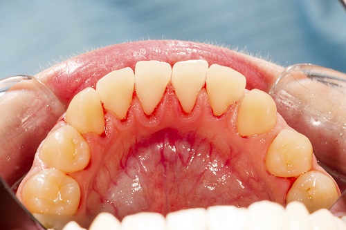 4 Stages of Periodontal Disease: What to Expect