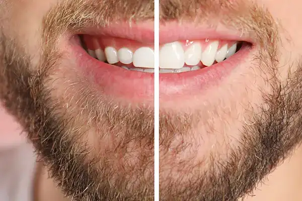Before and after comparison of a man's smile, highlighting enhanced gum shape and balanced teeth after crown lengthening.