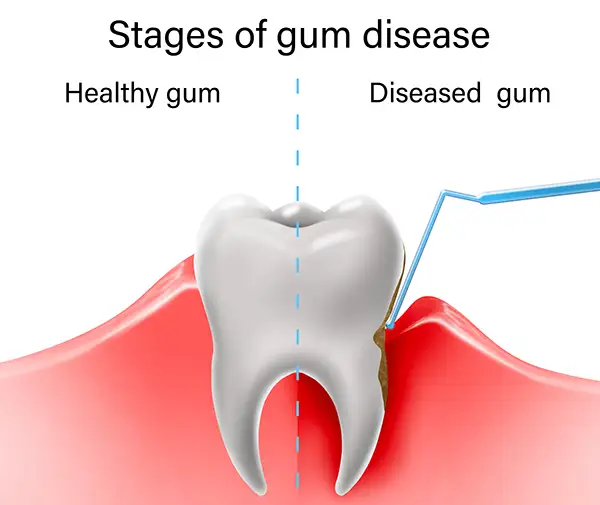 Illustration comparing a healthy gum to a diseased gum, showing tartar buildup and inflammation associated with gum disease.